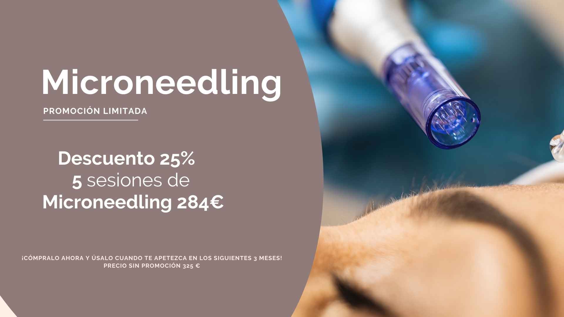 Microneedling enn Barcelona