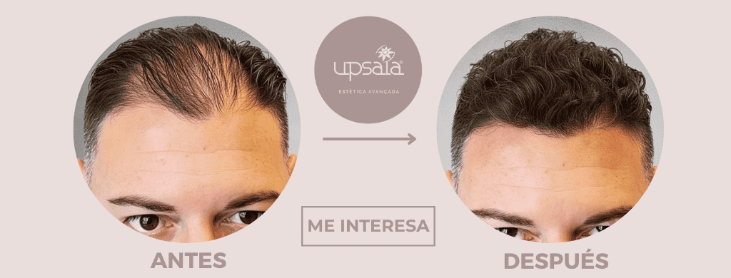 Micropigmentación Capilar en Barcelona Micropigmentación Capilar en Barcelona